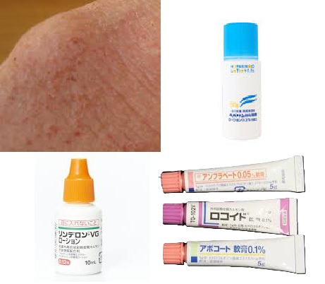 アトピー性皮膚炎（重症・紅皮症にも対応）