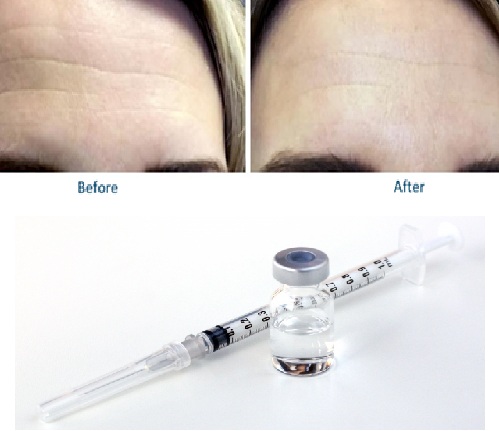 表情のしわ・クセ（おまかせボトックス）