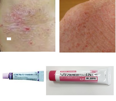 慢性の湿疹・かゆみ（慢性痒疹・乾癬）