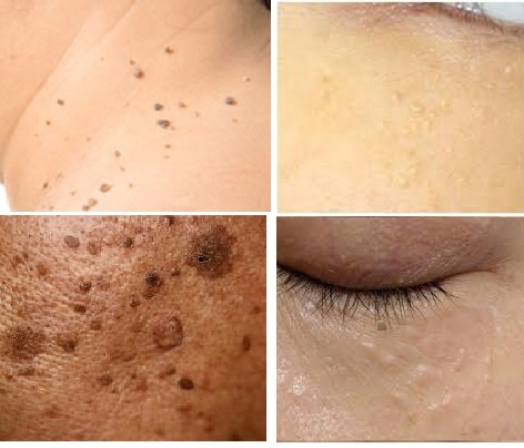 顔や首のプツプツ（脂漏性角化症・アクロコルドン）