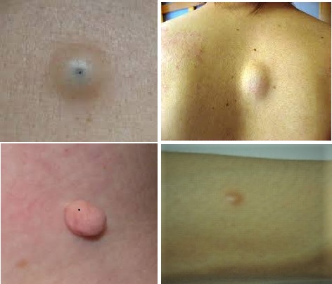 皮下のしこり・できもの（粉瘤・脂肪腫）