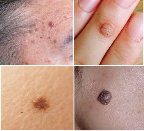 ほくろ・いぼ（色素性母斑・ウイルス性疣贅）
